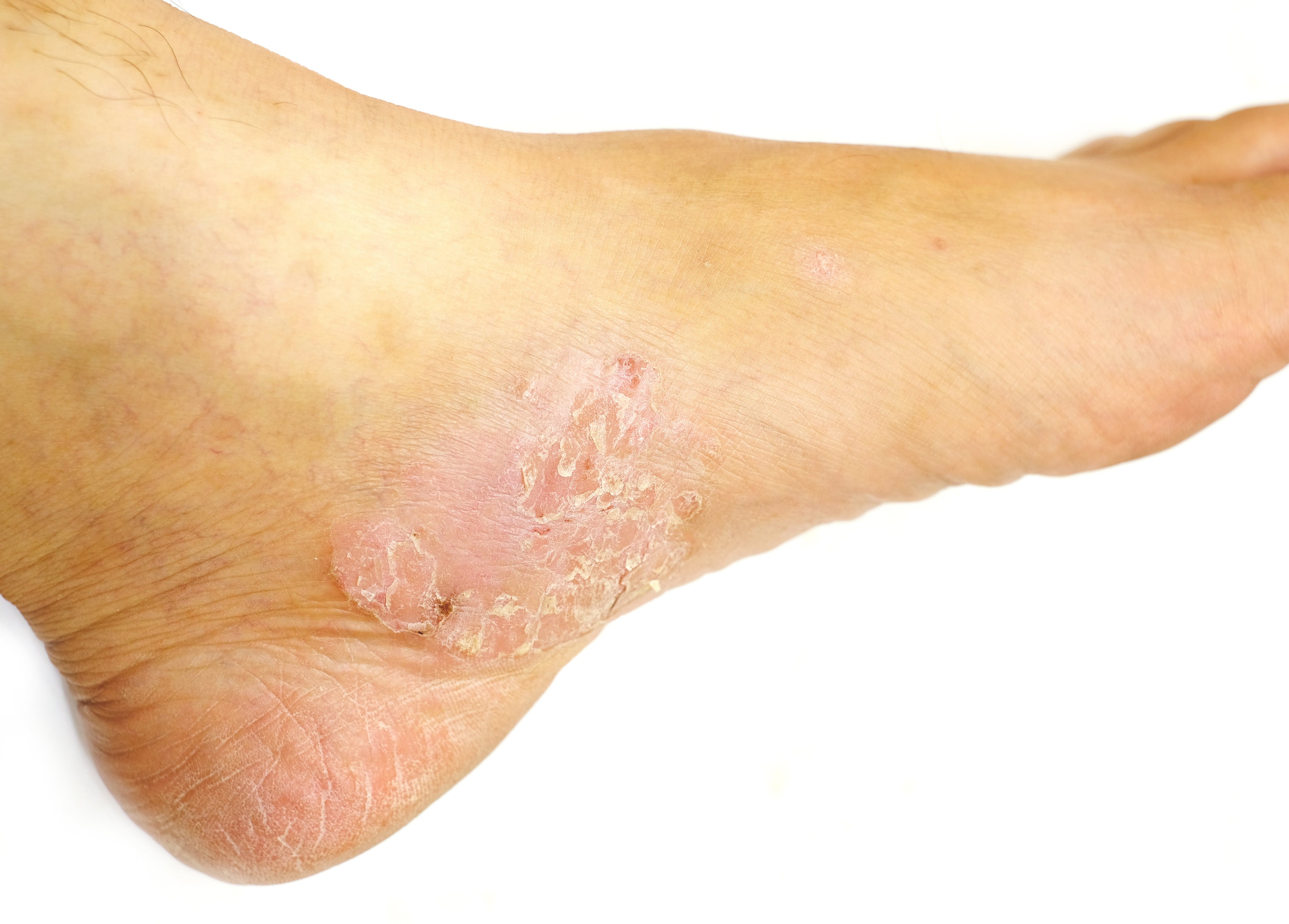 Close-up of a person's ankle and heel showing a severe, circular flare-up of eczema with thick, scaly, red, and cracked skin on a white background. This visual depicts symptoms of chronic inflammation.