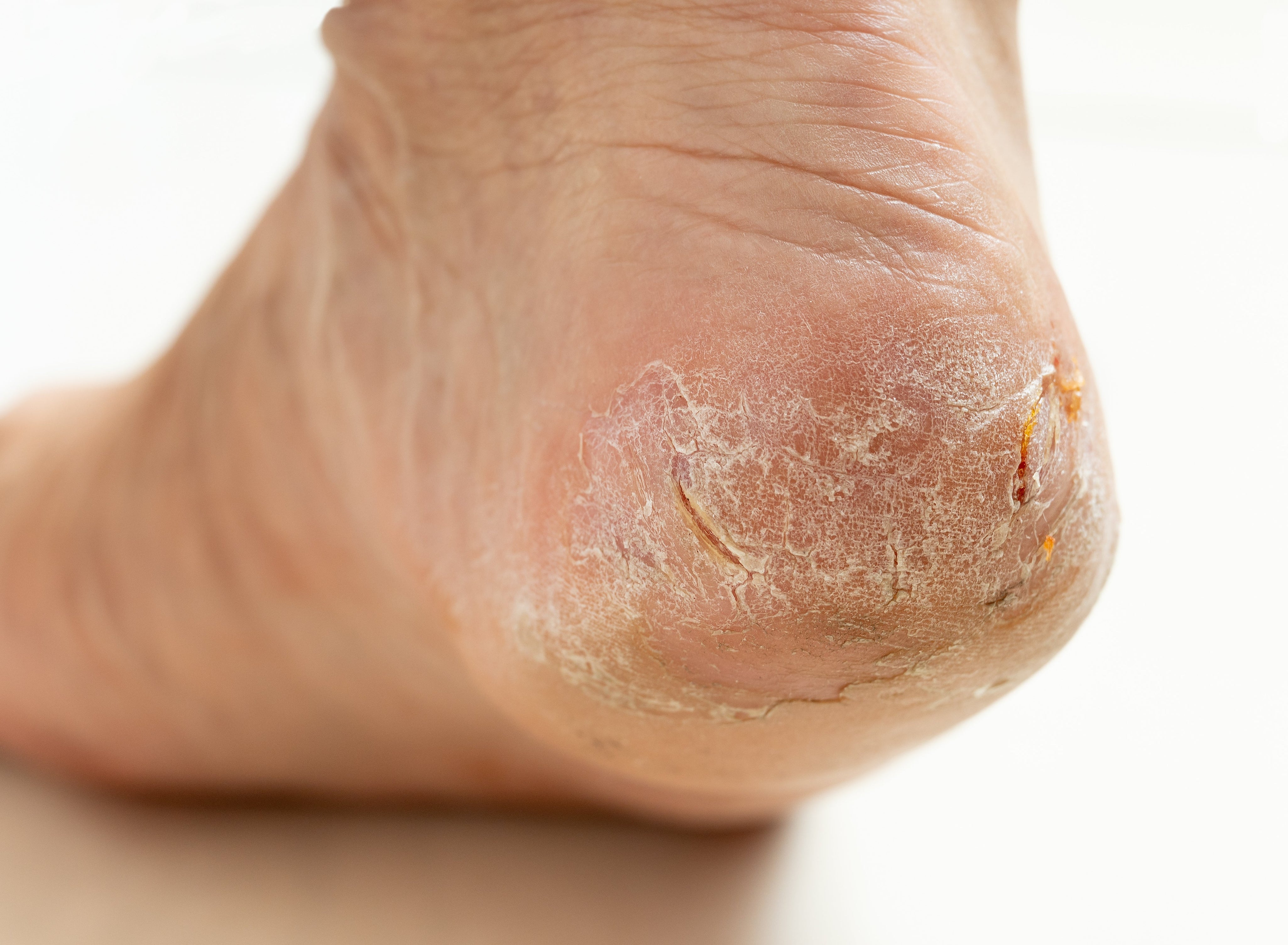 How to Heal Cracked Heels.