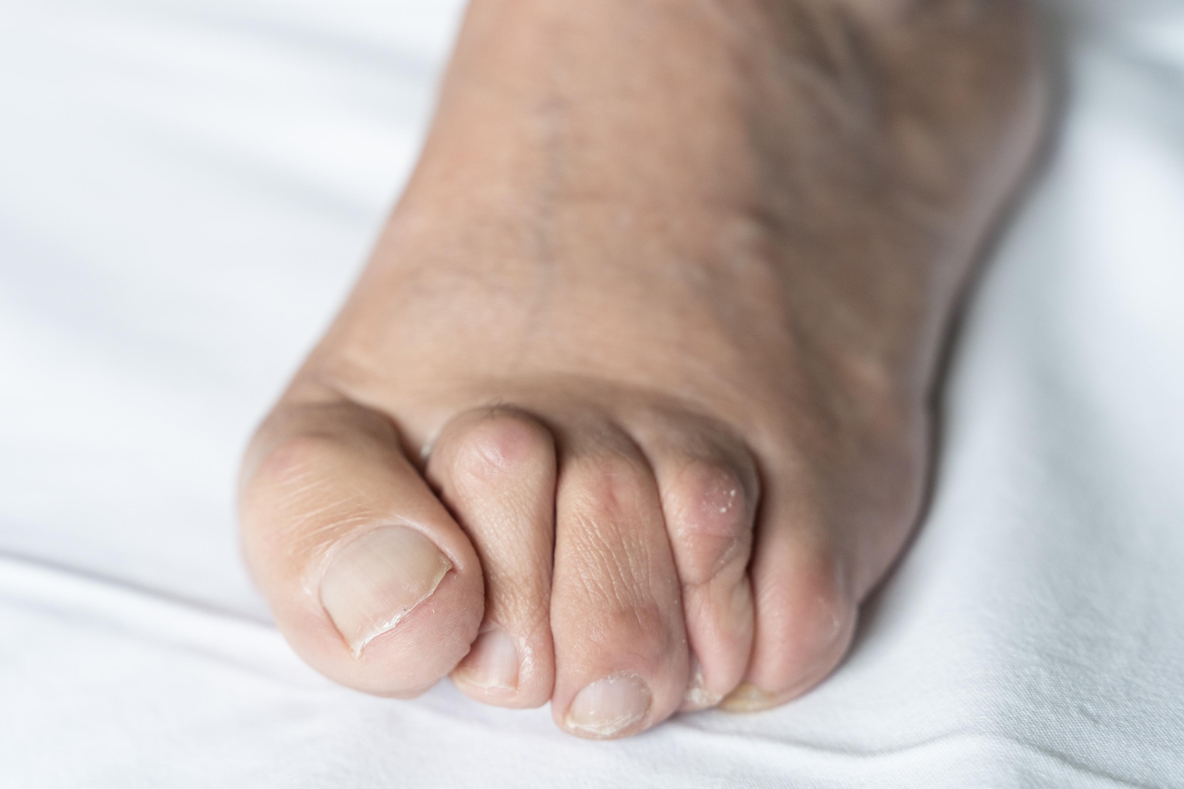 a foot with different types of hammer toe needing a hammer toe splint