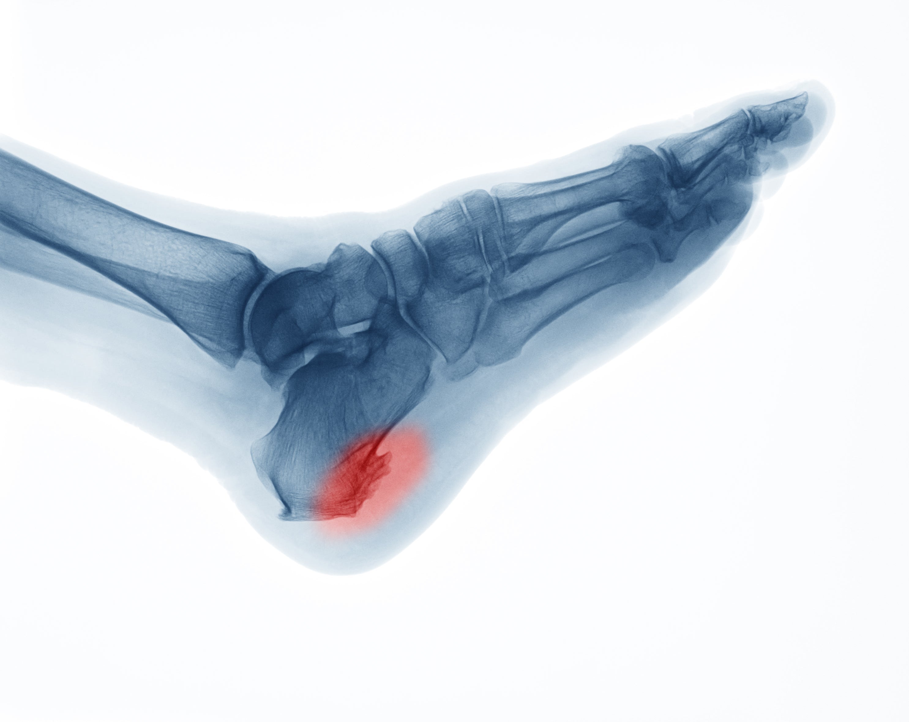 Heel Spur Treatment: What You Need to Know.
