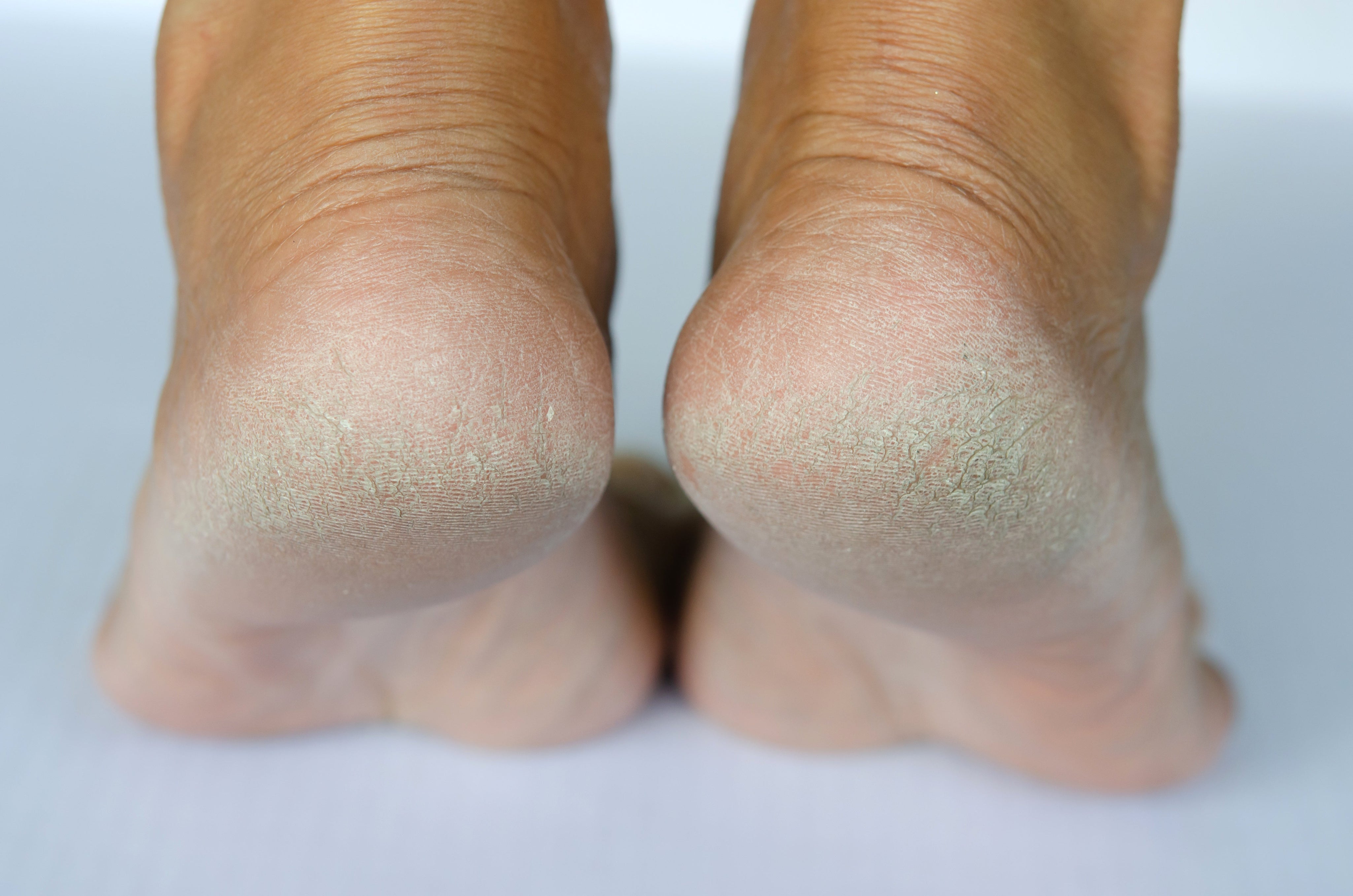 How to Heal Cracked Heels Quickly and Safely.