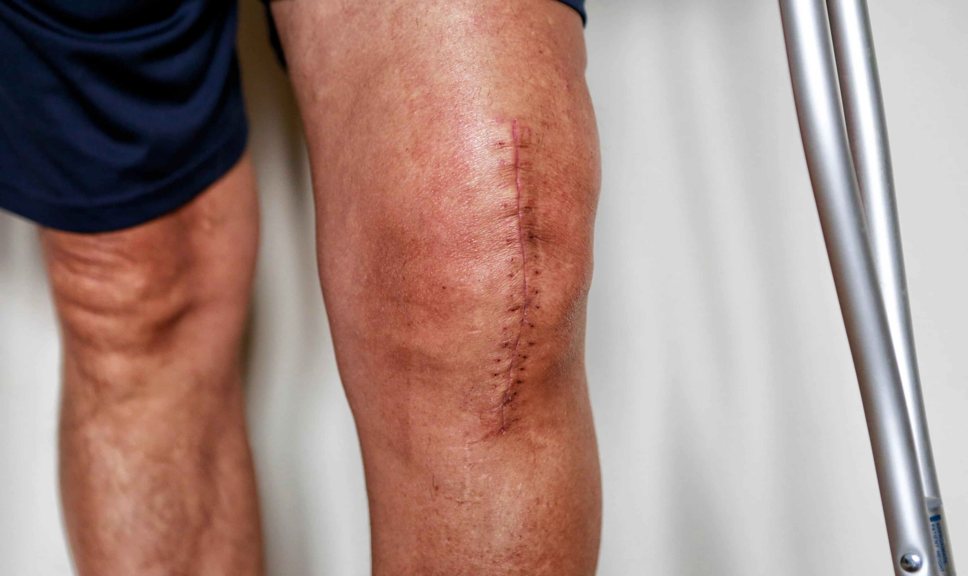 Ice Pack for Knee Replacement Recovery: Complete Guide