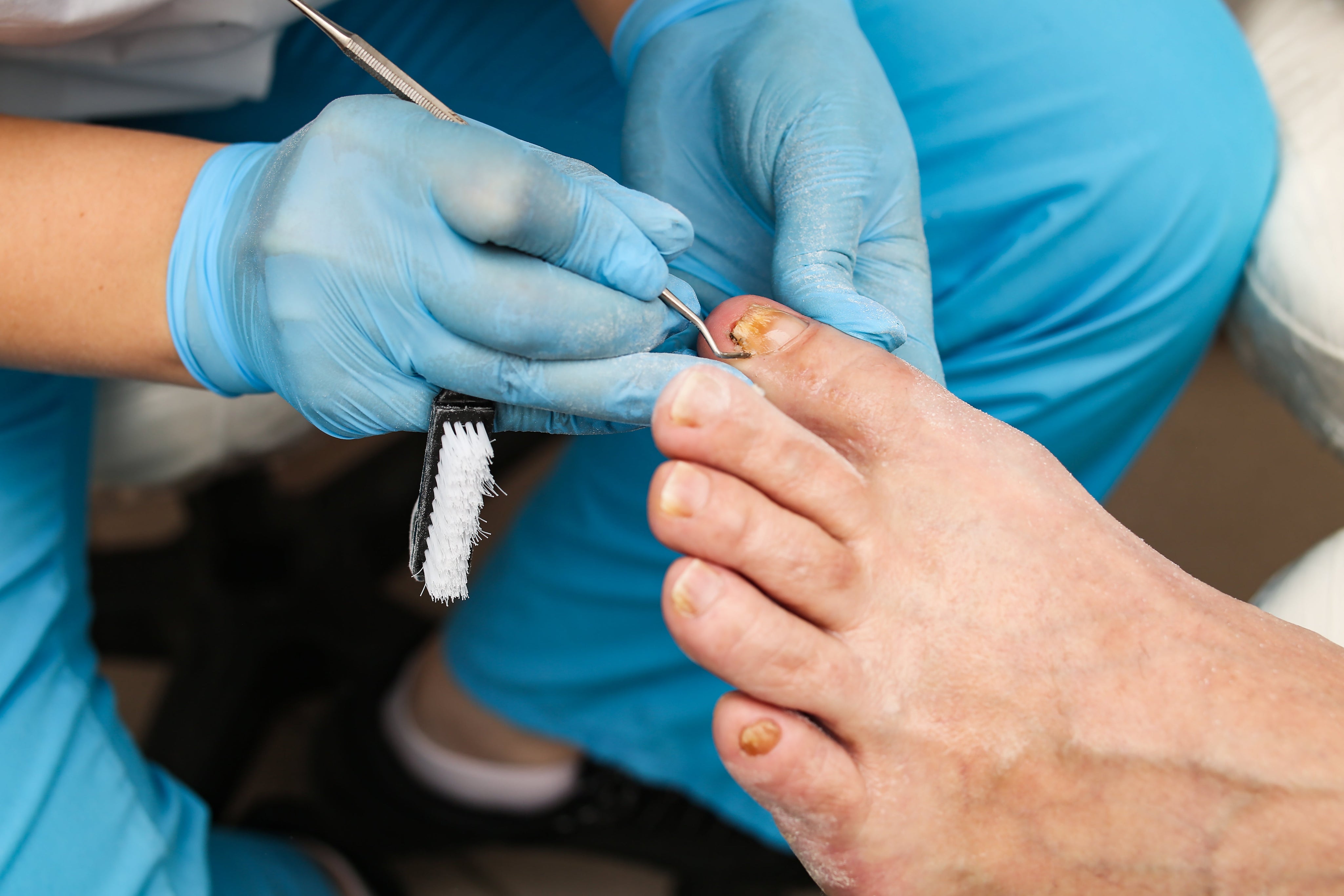 Understanding Ingrown Toenails: Causes, Symptoms, Home Care & Treatments.