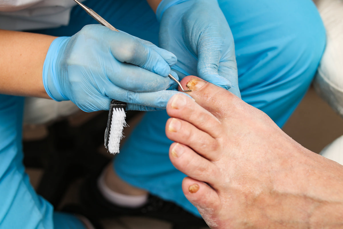 Ingrown Toenail: Causes, Symptoms & Treatment Guide - NatraCure