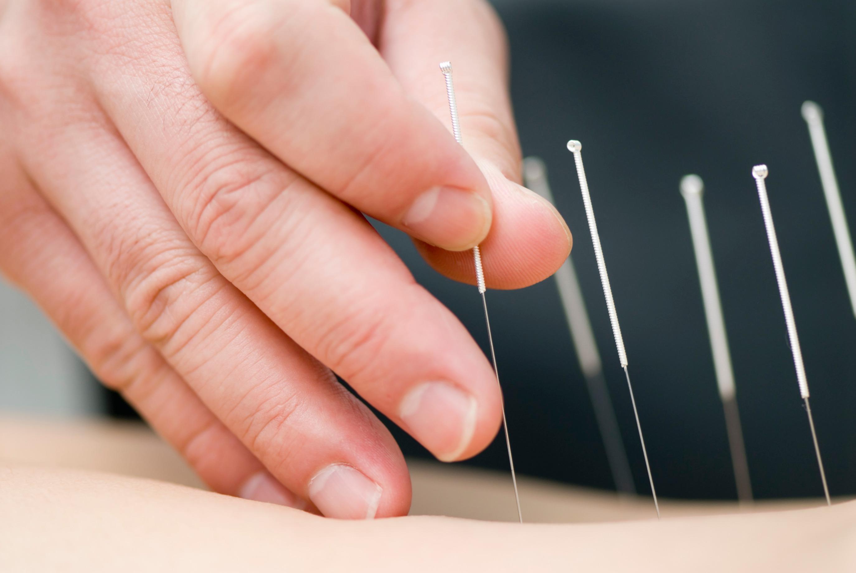 Acupuncture for Joint Pain: What To Know | NatraCure