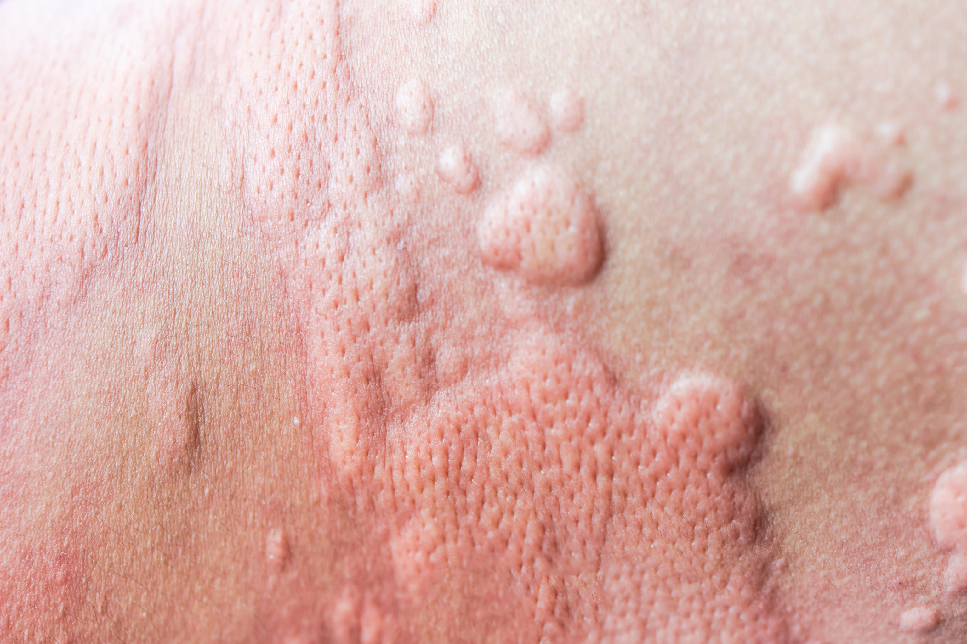 Can You Get Hives From Stress?