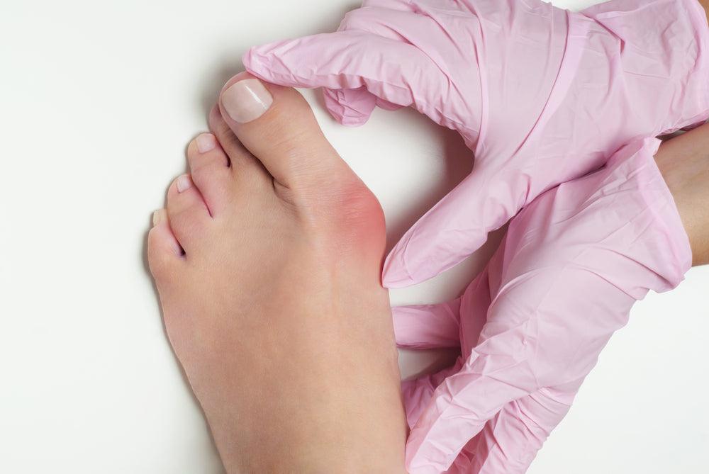 Four Ways to Identify a Bunion | NatraCure