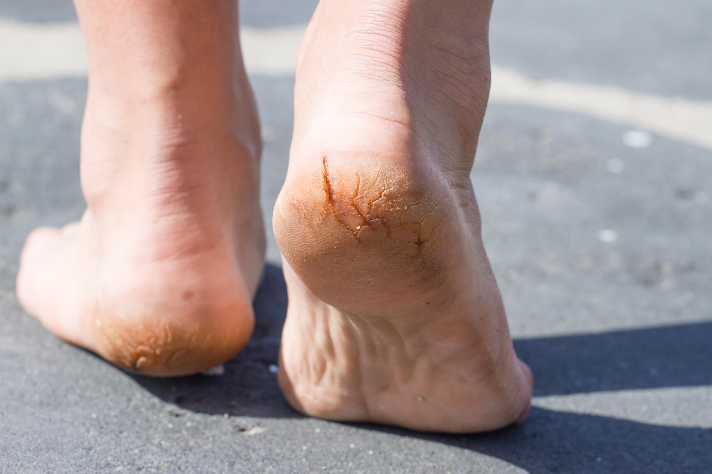 How to Heal Cracked Heels