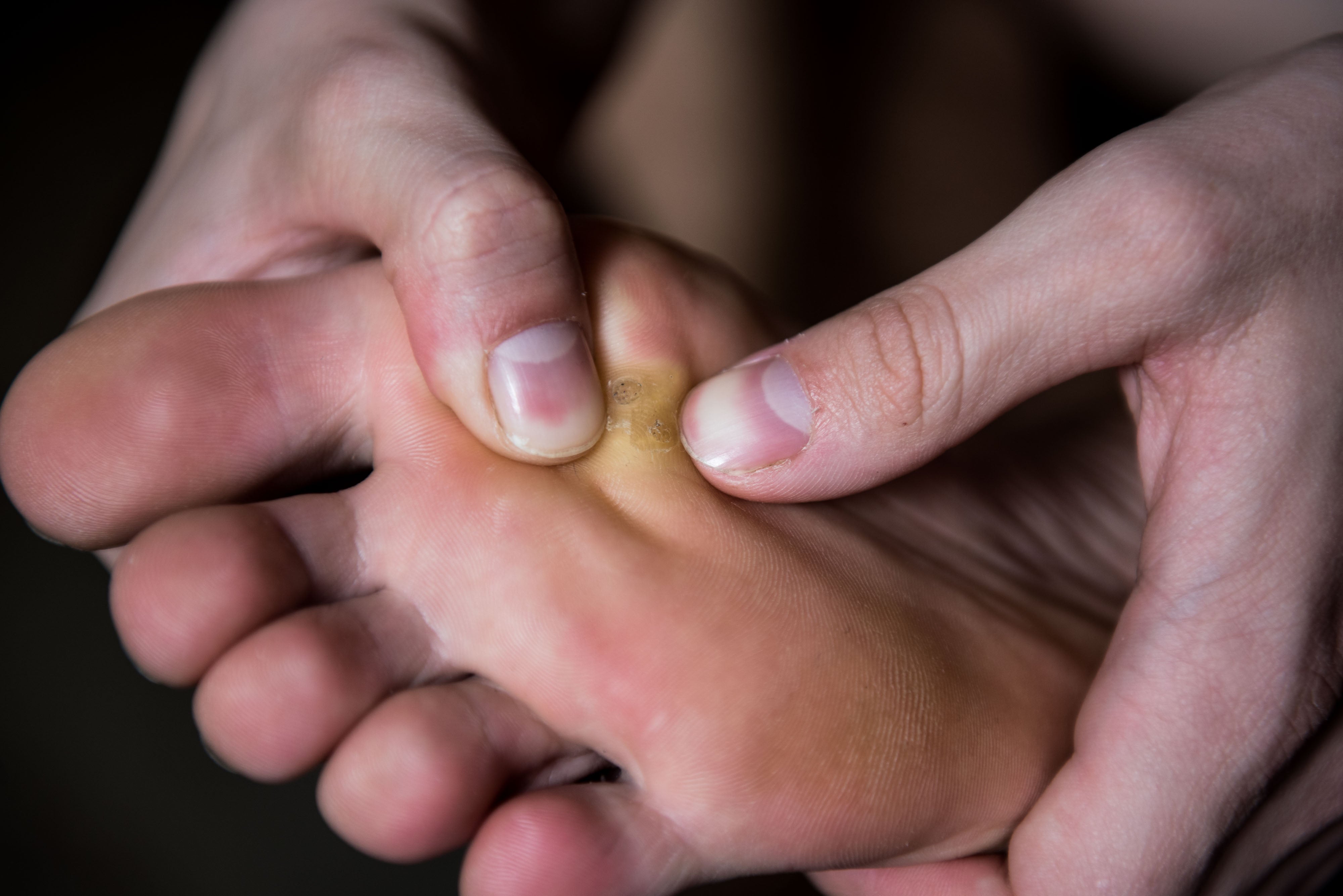 close up of a person examining a callus on the bottom of their foot