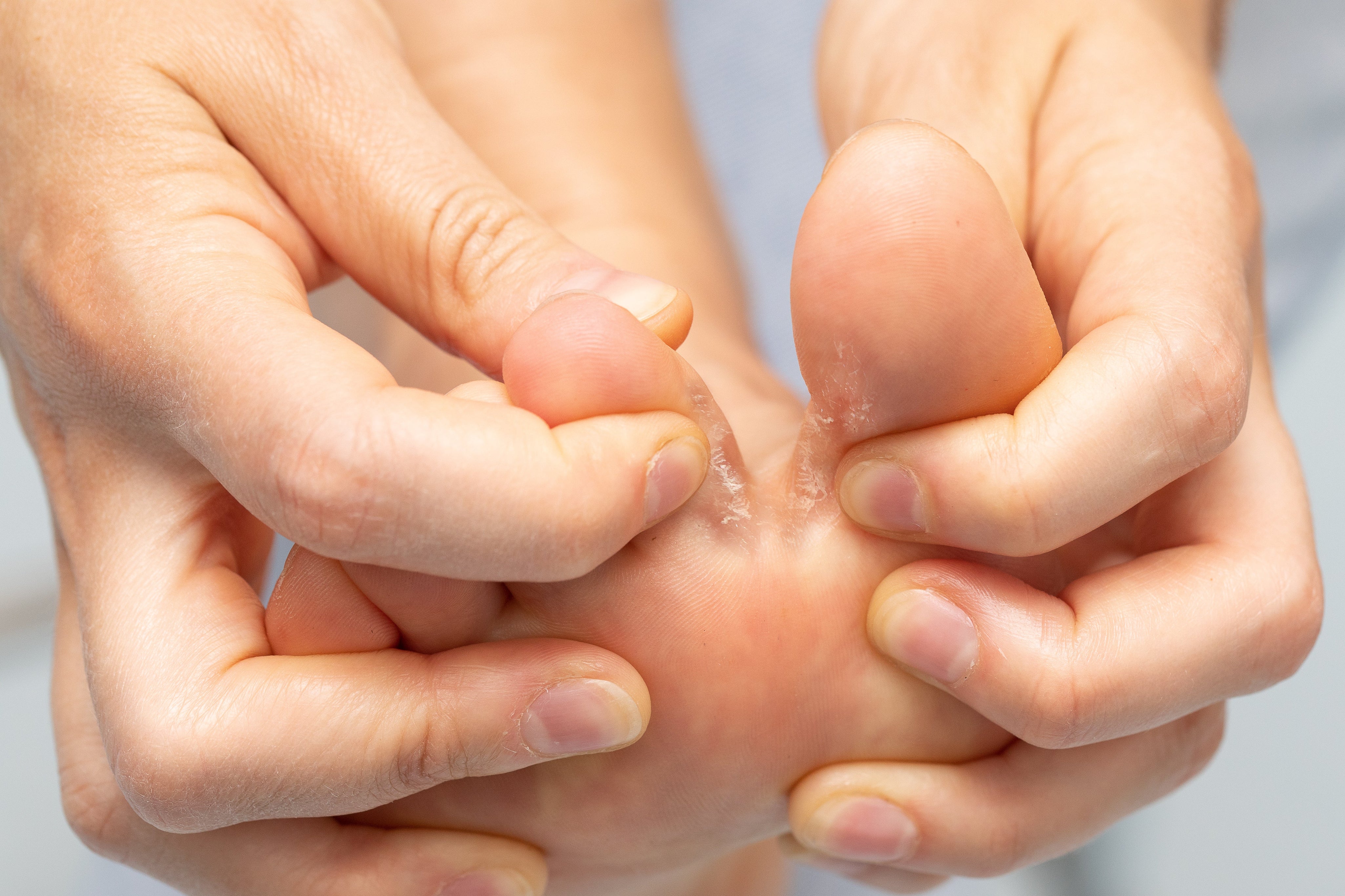 A close-up of a person gently pulling apart their toes to show peeling, flaky skin between them, a common sign of athlete’s foot or very dry skin.